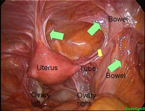 The uterus is hanging with adhesions in the abdominal wall after a C-section 