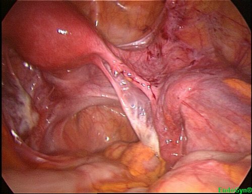 Here one can see how dense the adhesions between the bowel and the anterior 